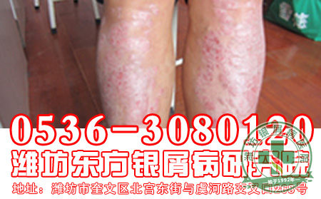 牛皮癣护理