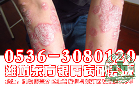 牛皮癣护理