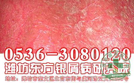 牛皮癣饮食