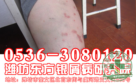 男性牛皮癣的诱发因素有哪些呢