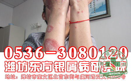 点滴型银屑病常见的症状有哪些？