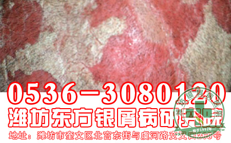  小儿银屑病有哪些症状表现？