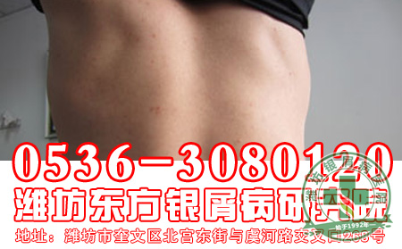 如何诊断头部银屑病?