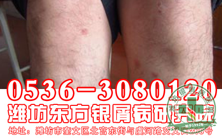 银屑病会隔代遗传吗？