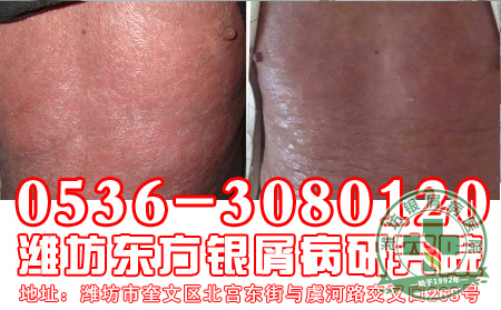 银屑病医院公交车路线【牛皮癣品牌专科】