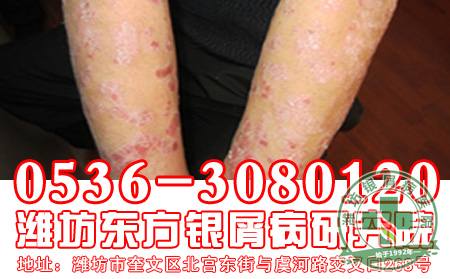 牛皮癣患者外出旅游要注意什么?