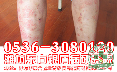 女性银屑病患者可以吃减肥药啊?