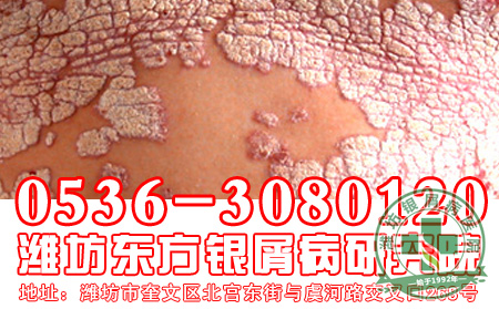 浅谈银屑病遗传
