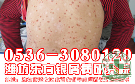 牛皮癣暂时治疗了还要注意什么吗?