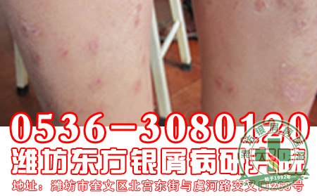 牛皮癣患者外出旅游注意什么