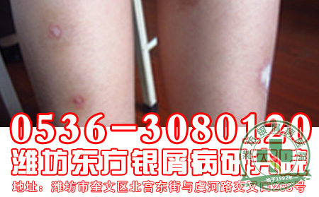 浅谈内分泌代谢与银屑病的关系