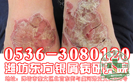 合理食用南瓜，赶走银屑病！