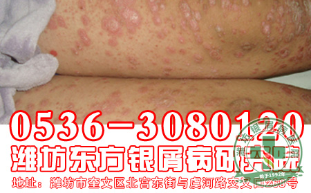 主任简述：银屑病治疗过程中饮食禁忌