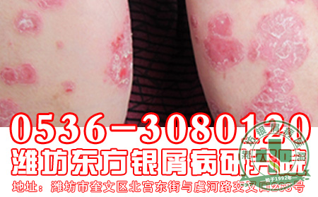 银屑病患者沐浴根据不同病情而定!