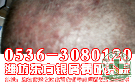 银屑病冬季运动应该遵循什么原则?【新闻专题