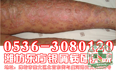 银屑病患者感冒吃什么好?