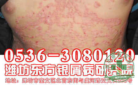 主任和你聊聊银屑病护理问题