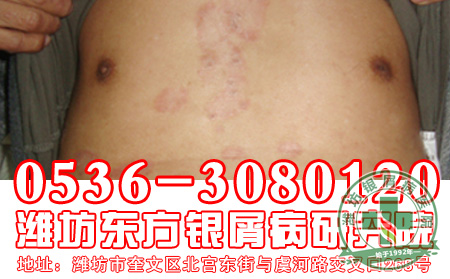 银屑病患者在治疗过程中可以使用偏方吗?【