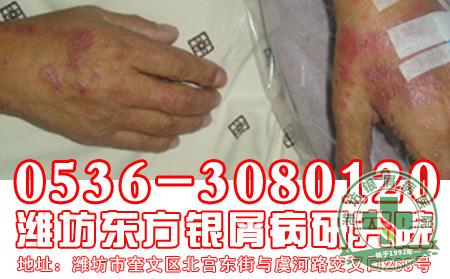 银屑病患者如何做好预防工作？