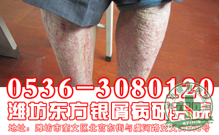 银屑病患者要注意哪些心理上的问题?