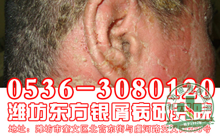 头部银屑病患者洗头注意哪些方面？