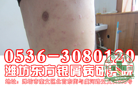 银屑病的治疗应该从哪些方面做起?