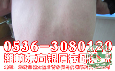 银屑病治疗怎么用药 好?