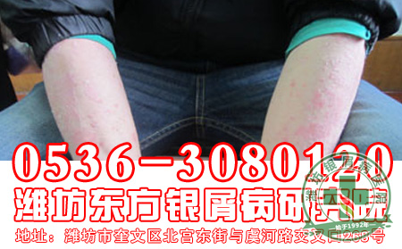 银屑病发病后怎样防止复发？