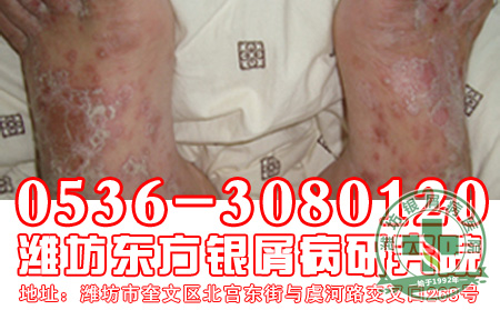 谁是造成牛皮癣发病加重的罪魁【 治疗】