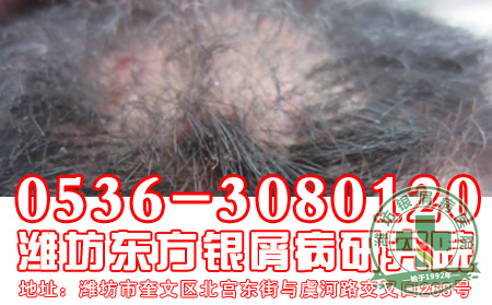 银屑病的治疗工作应该做到哪几点?