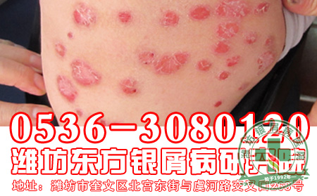 食疗治疗银屑病，安全又健康