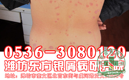 银屑病发病与患者的哪些因素有关?