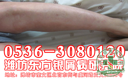 银屑病治疗使用的药物要注意什么？