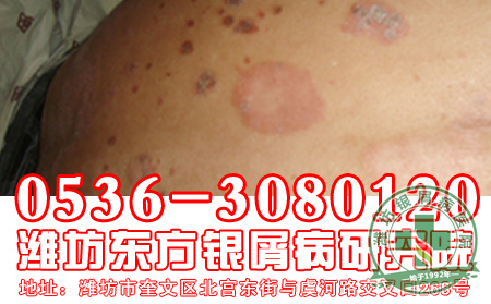 主任导读:银屑病是一种怎样的疾病?【牛皮癣