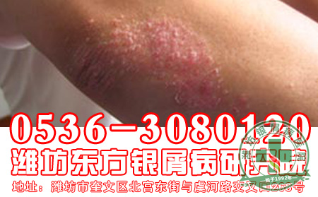 牛皮癣病情轻微需要治疗吗？