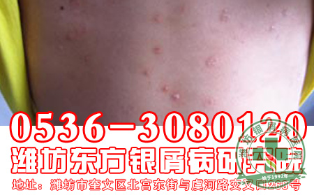 寻常型牛皮癣久治不愈的原因有什么？【平价医