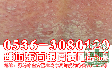 怎么治疗寻常型银屑病?
