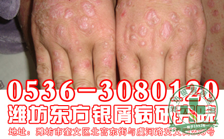 女性银屑病患者经期护理要点
