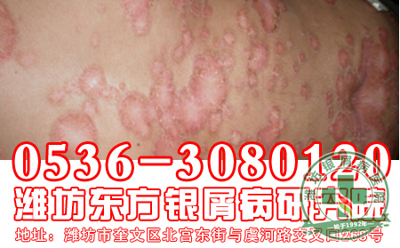 紫草治疗银屑病的药理作用