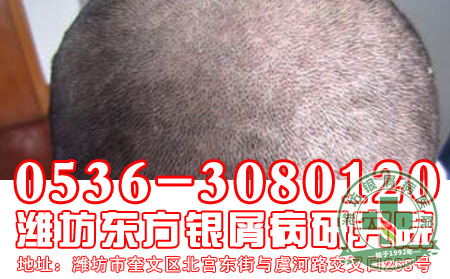 银屑病容易造成患者皮肤瘙痒出现吗?【定