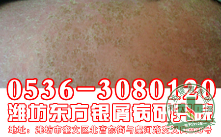 牛皮癣发病与哪些微量元素有着关系?【牛皮癣