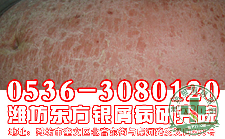 牛皮癣患者的病情怎样进行诊断？【 医院】