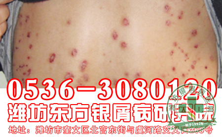 怎么避免银屑病遗传