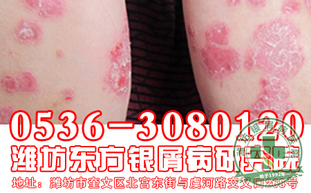 吃什么可以帮助银屑病患者减轻压力？