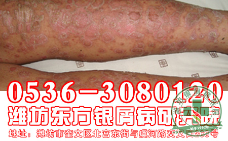 婴儿得银屑病注意事项有哪些?