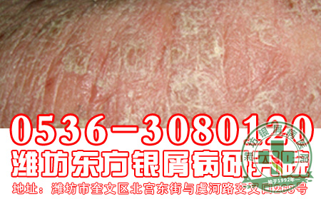 悲伤过度是银屑病常见病因之一吗?【 先进】