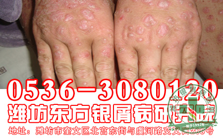 悲观情绪对银屑病的影响