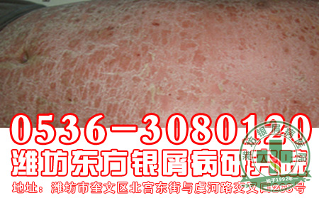 济南银屑病专科医院告诉大家银屑病遗传有关问题