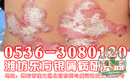 济南银屑病专科医院——主任浅谈：儿童银屑病