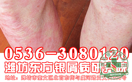 脓疱型银屑病发病有什么表现?